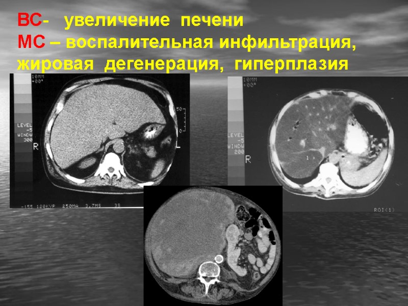 ВС-   увеличение  печени МС – воспалительная инфильтрация, жировая  дегенерация, 
